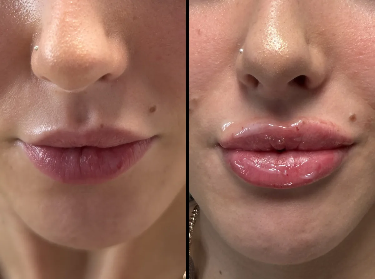Lips before (left) and after (right) treatment, front view