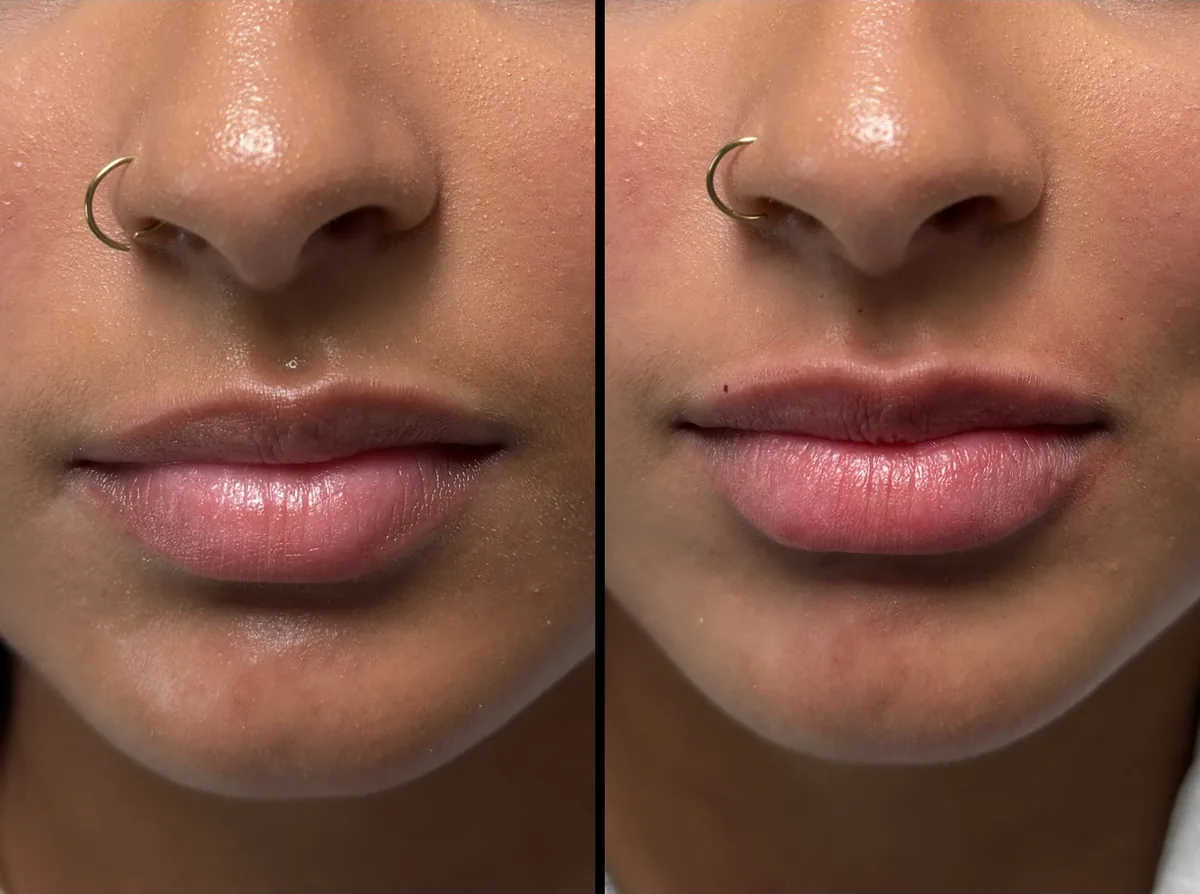 Lips before (left) and after (right) treatment, front view