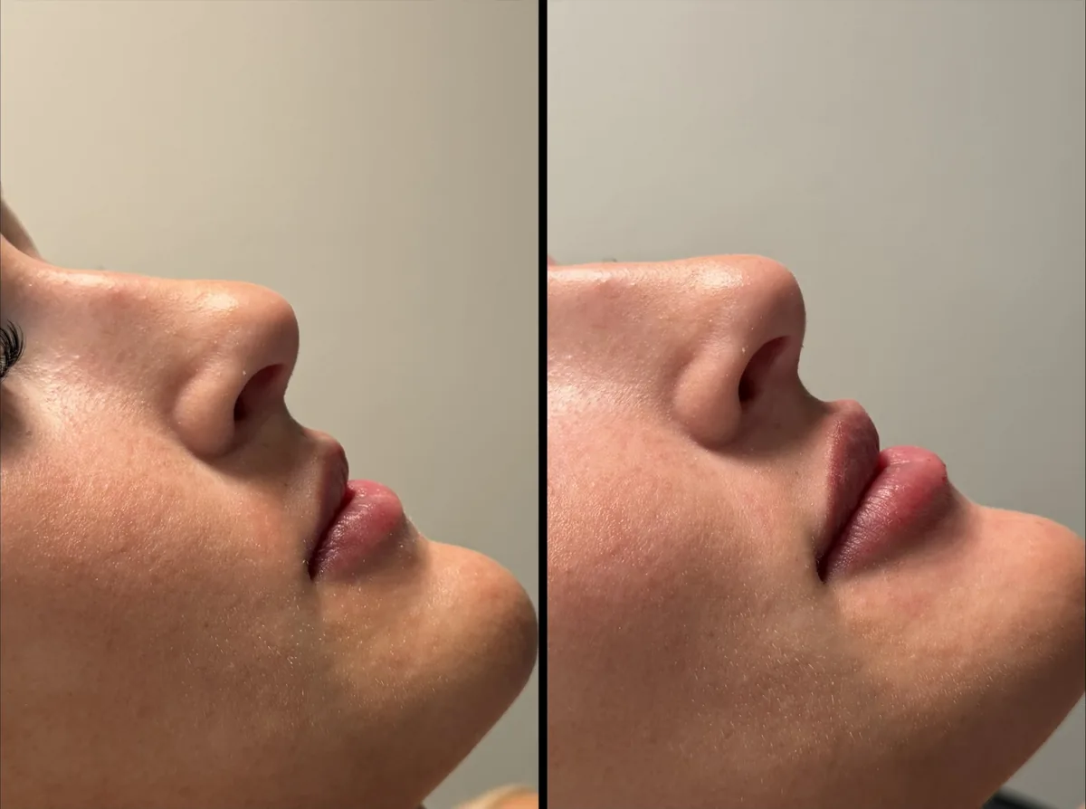 Lips before (left) and after (right) treatment, side profile