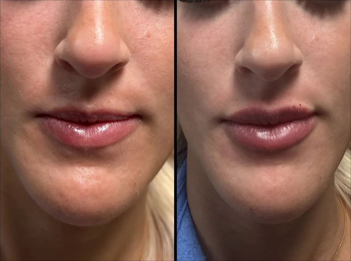 Lips before (left) and after (right) treatment, front view